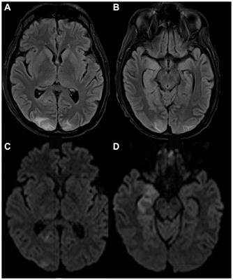 Neurological manifestations of nontuberculous mycobacteria in adults: case series and review of the literature